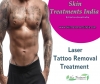Tattoo Removal Treatment in Delhi